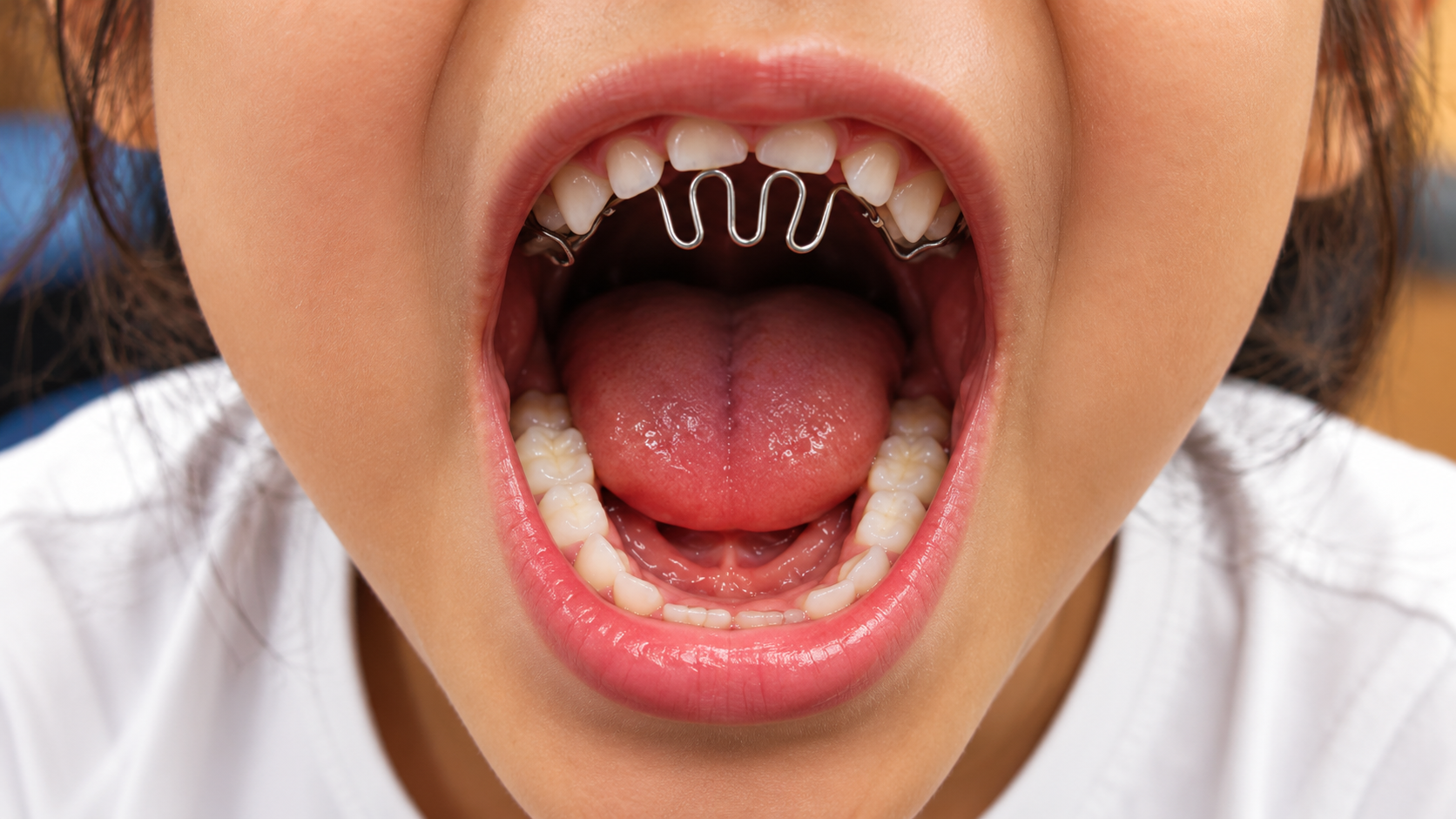 Habit Breaking Appliances: Helping Correct Harmful Oral Habits in Children