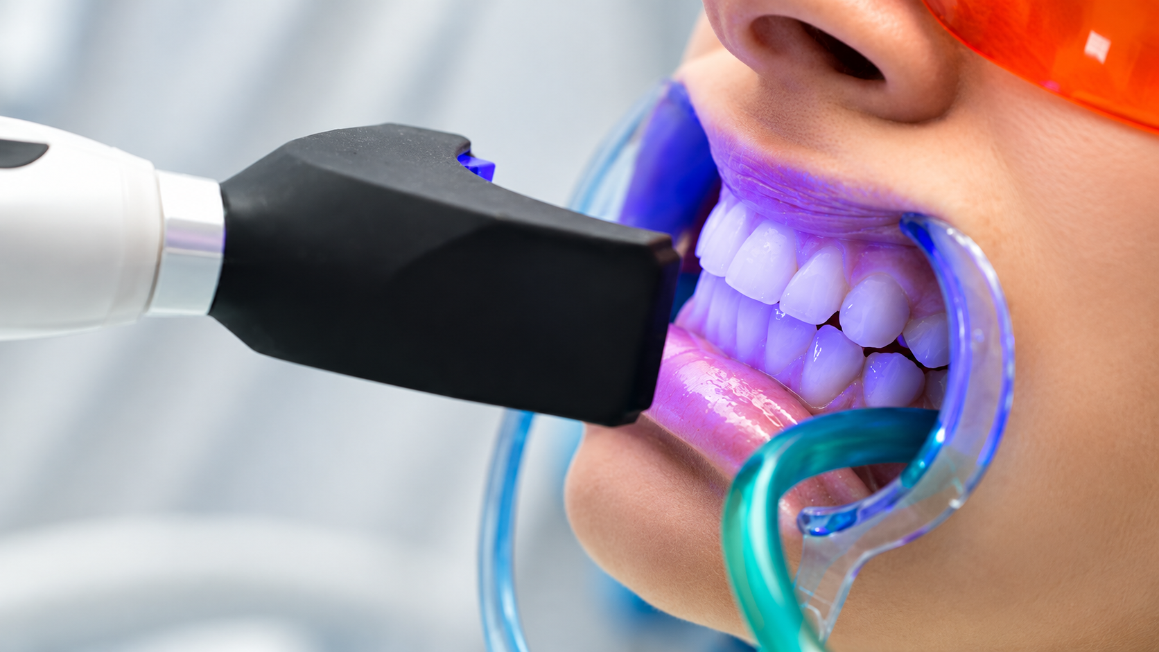 Teeth Whitening & Bleaching: A Simple Way to Brighten Your Smile